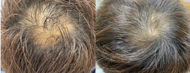 頭頂が増毛しました。