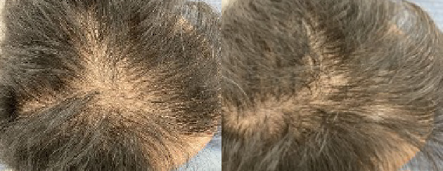 頭頂が増毛しました。