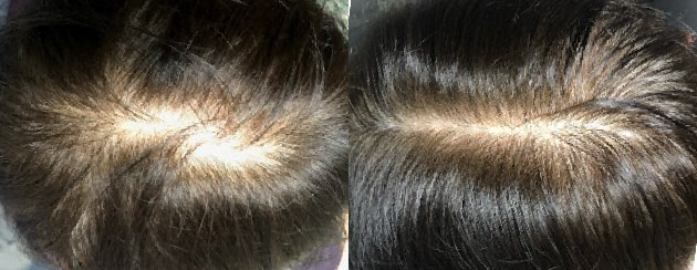 頭頂が増毛しました。