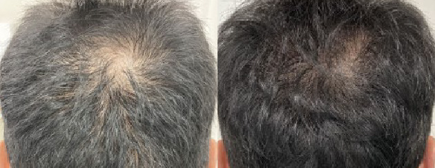 全体に頭髪の密度が増しました。
