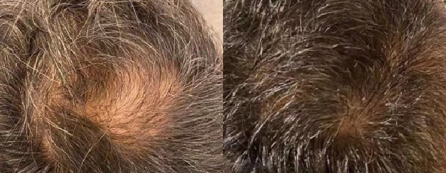 頭頂を中心とした広い範囲の脱毛が改善しました。